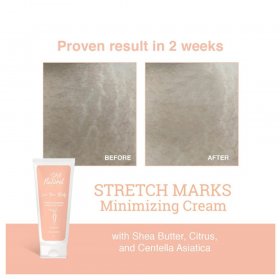 Stretch Mark Minimizing Cream (100g)